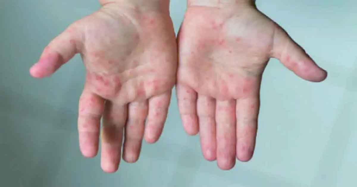 হাম আক্রান্ত শিশু, ছবিঃ সংগৃহীত 